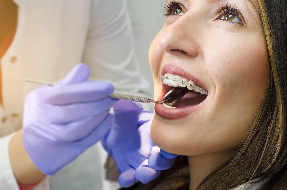 Fotografija: Z ortodontom se posvetujte, kateri aparat je najbolj primeren za vas. FOTOGRAFIJE: Getty Images