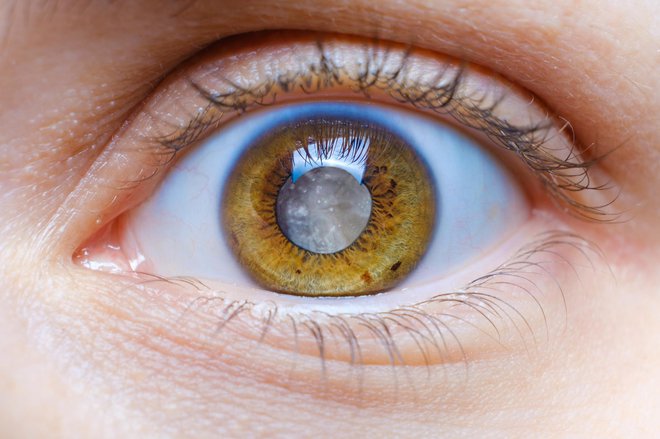 Napredovala oblika katarakte se lahko opazi s prostim očesom zaradi spremembe barve zenice, ki postane belkasta. FOTO: Zarina Lukash/Getty Images