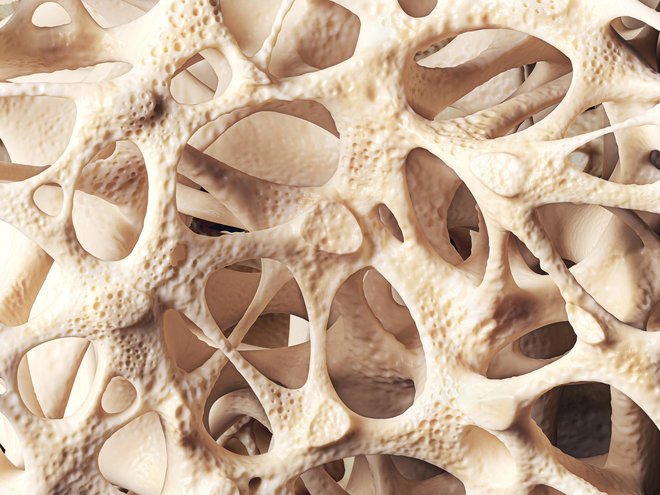 Osteoporoza je bolezen, pri kateri kosti postanejo šibke in nagnjene k zlomom. FOTO: Eranicle, Getty Images