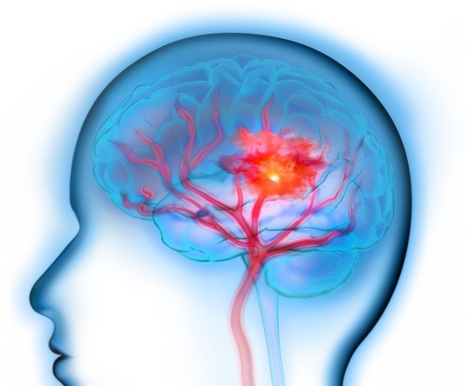 Za zgodnje prepoznavanje simptomov možganske kapi se spomnite na kratico GROM. FOTO: Peterschreiber.media/Getty Images