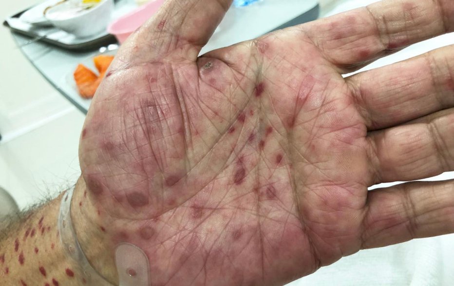 Fotografija: Posledice sifilisa na dlaneh. FOTO: Getty Images