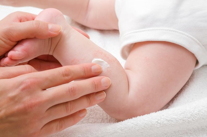 Bolezen se običajno začne že pri dojenčkih. FOTO: FotoDuets/Getty Images/iStockphoto