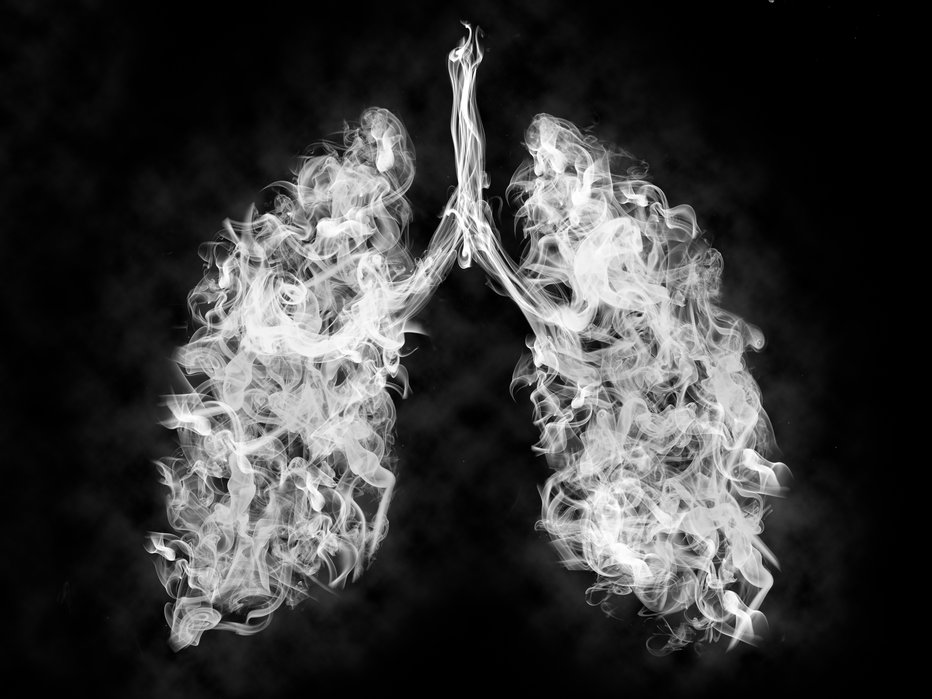 Fotografija: Glavni vzrok nastanka pljučnega raka je aktivno kajenje. FOTOGRAFIJI: Guliver/Getty Images