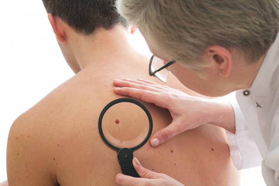 Fotografija: Če se znamenje spremeni, obiščite dermatologa. FOTO: Guliver/Getty Images