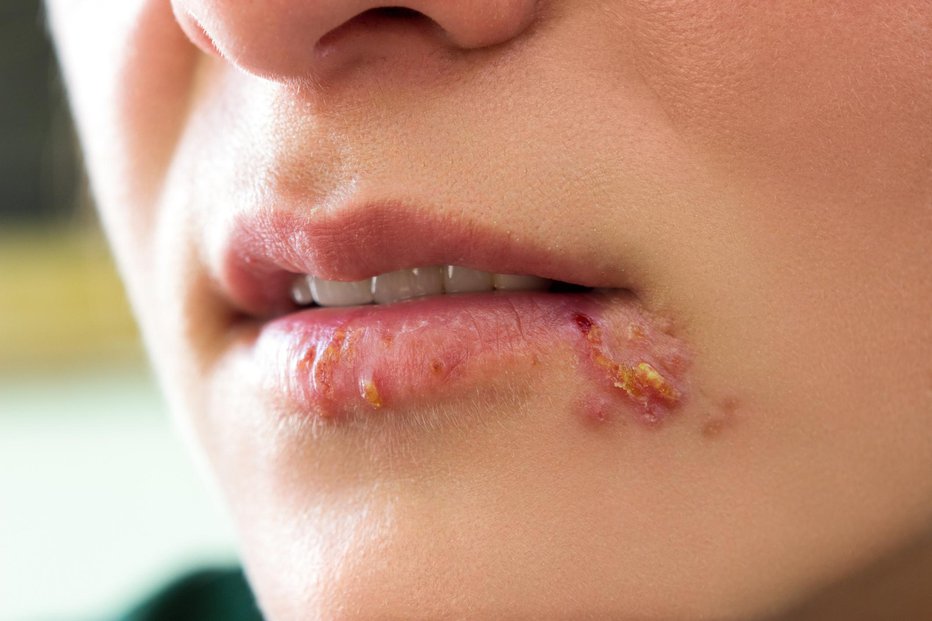 Fotografija: Herpes simplex največkrat prizadene ustnice. FOTO: Cherriesjd, Getty Images