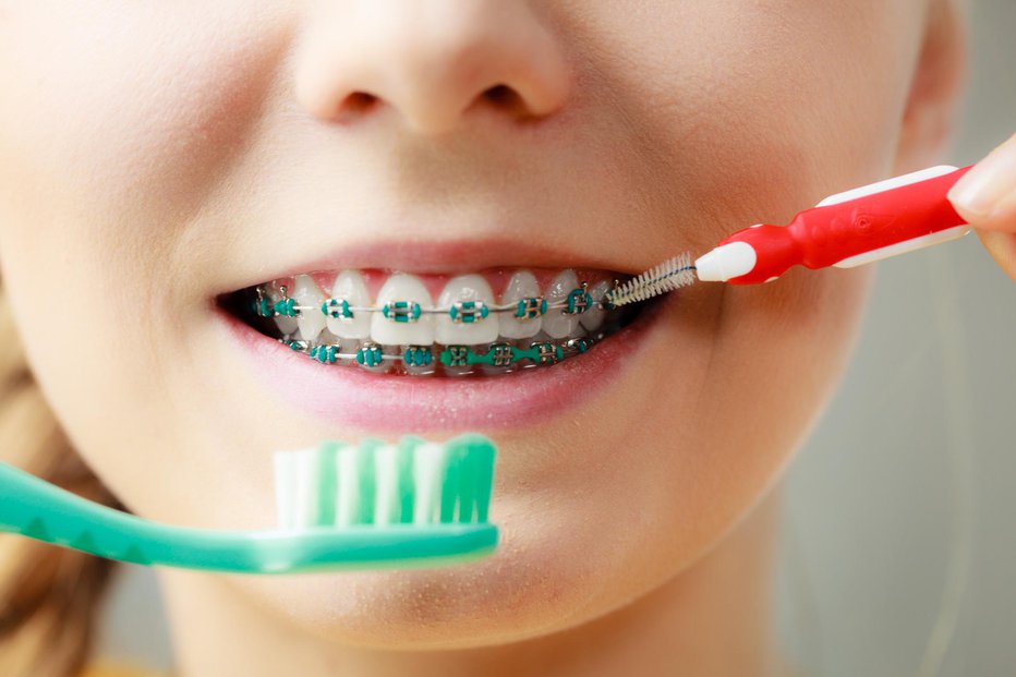 Fotografija: Nega je pri uporabi ortodontskih pripomočkov izjemno pomembna. FOTO: Voyagerix/Getty Images
