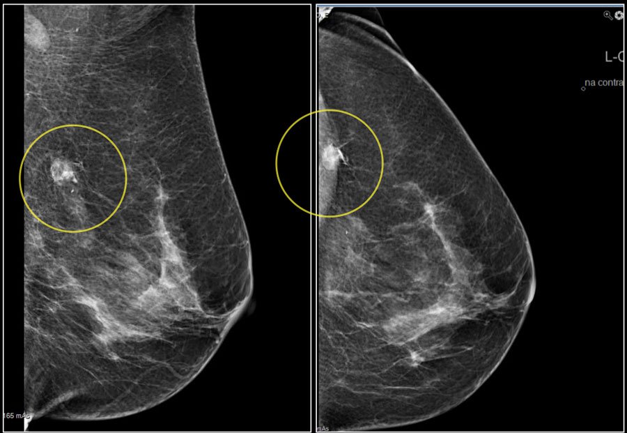 Fotografija: Orodje je analiziralo mamografske slike več kot 10.000 žensk. FOTO: Facebook