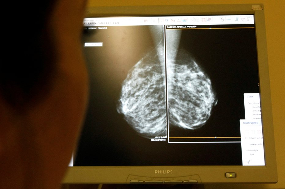 Fotografija: Mamografska slika. FOTO: Eric Gaillard Reuters